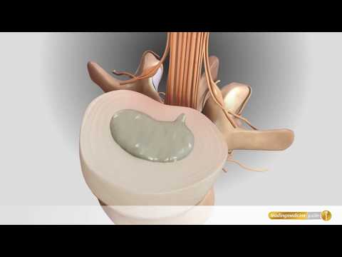 Bandscheibenprothese Spezialsten Finden Leading Medicine Guide