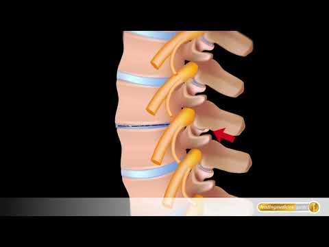 Spondylose Mit Radikulopathie Lumbalbereich - Captions Profile