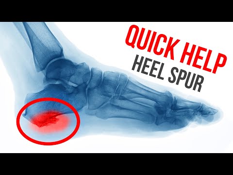 What Is Heel Spurs? Causes, Symptoms & Treatment Options – BodyHeal