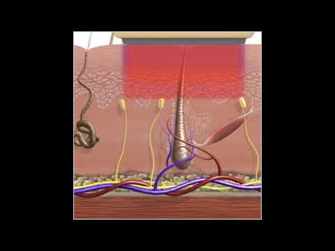 Laser Haarentfernung Bei S Thetic Derma In Frankfurt